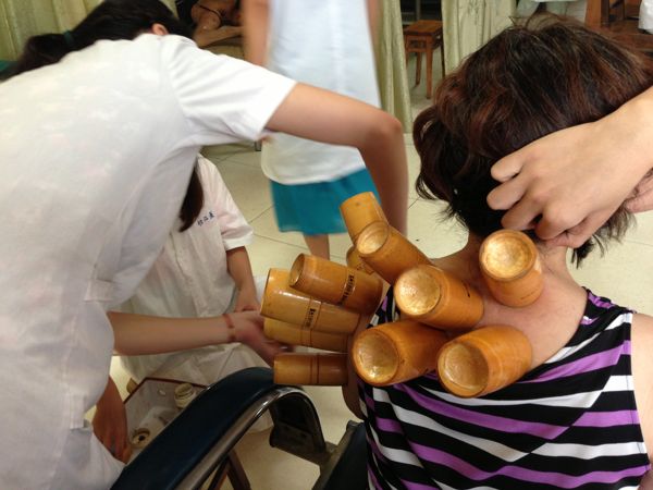 Cupping