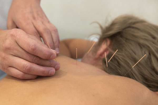 acupuncture