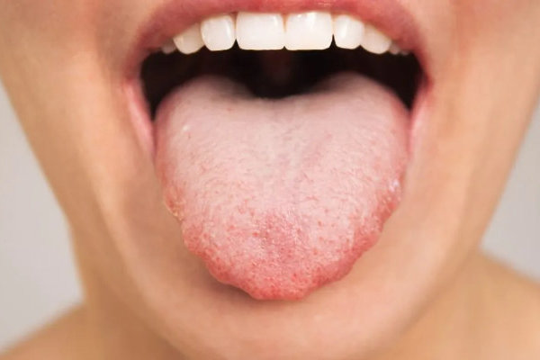 langue-marque-dents 600x400
