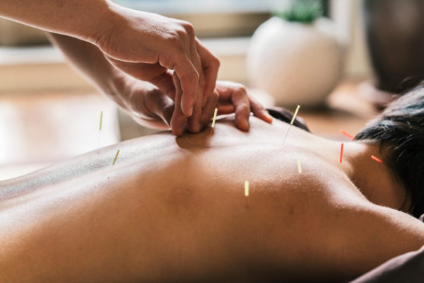 acupuncture to relieve stress
